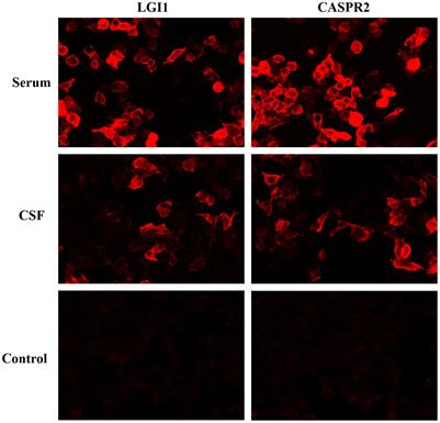 Phenotypic Spectrum of CASPR2 and LGI1 Antibodies Associated Neurological Disorders in Children
